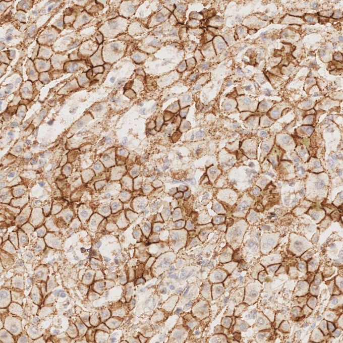 IHC staining of Cholangiocarcinoma using 82968-1-RR IHC staining of Cholangiocarcinoma using 82968-1-RR