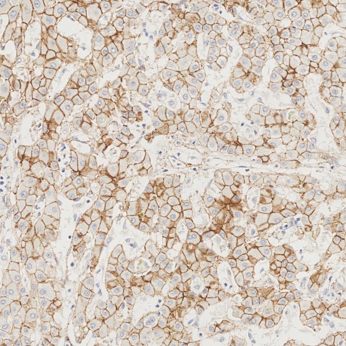 IHC staining of Cholangiocarcinoma using 82968-1-RR IHC staining of Cholangiocarcinoma using 82968-1-RR