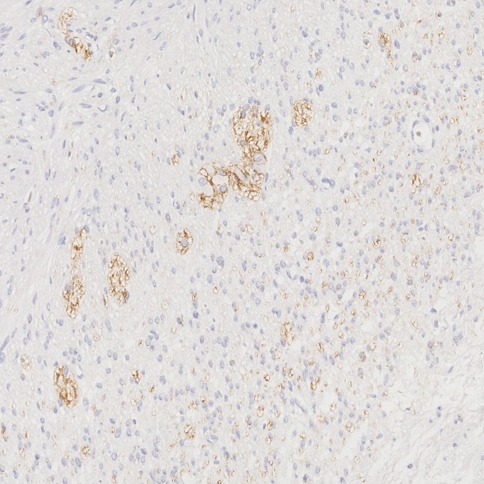 IHC staining of human appendicitis using 82968-1-RR IHC staining of human appendicitis using 82968-1-RR