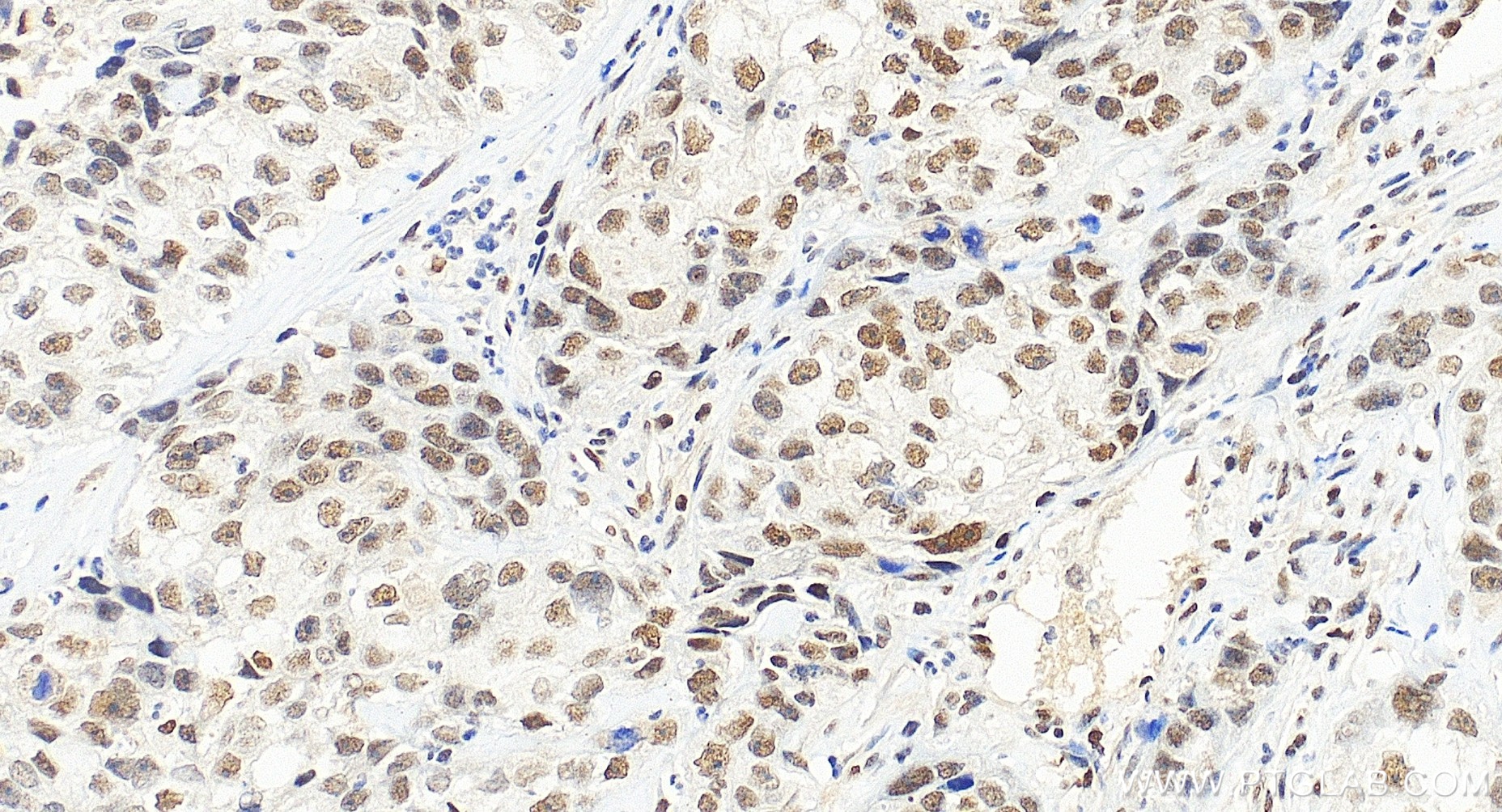 IHC staining of human ovary cancer using 85380-2-RR