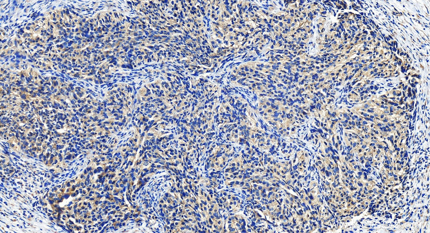 IHC staining of human ovary cancer using 12519-1-AP