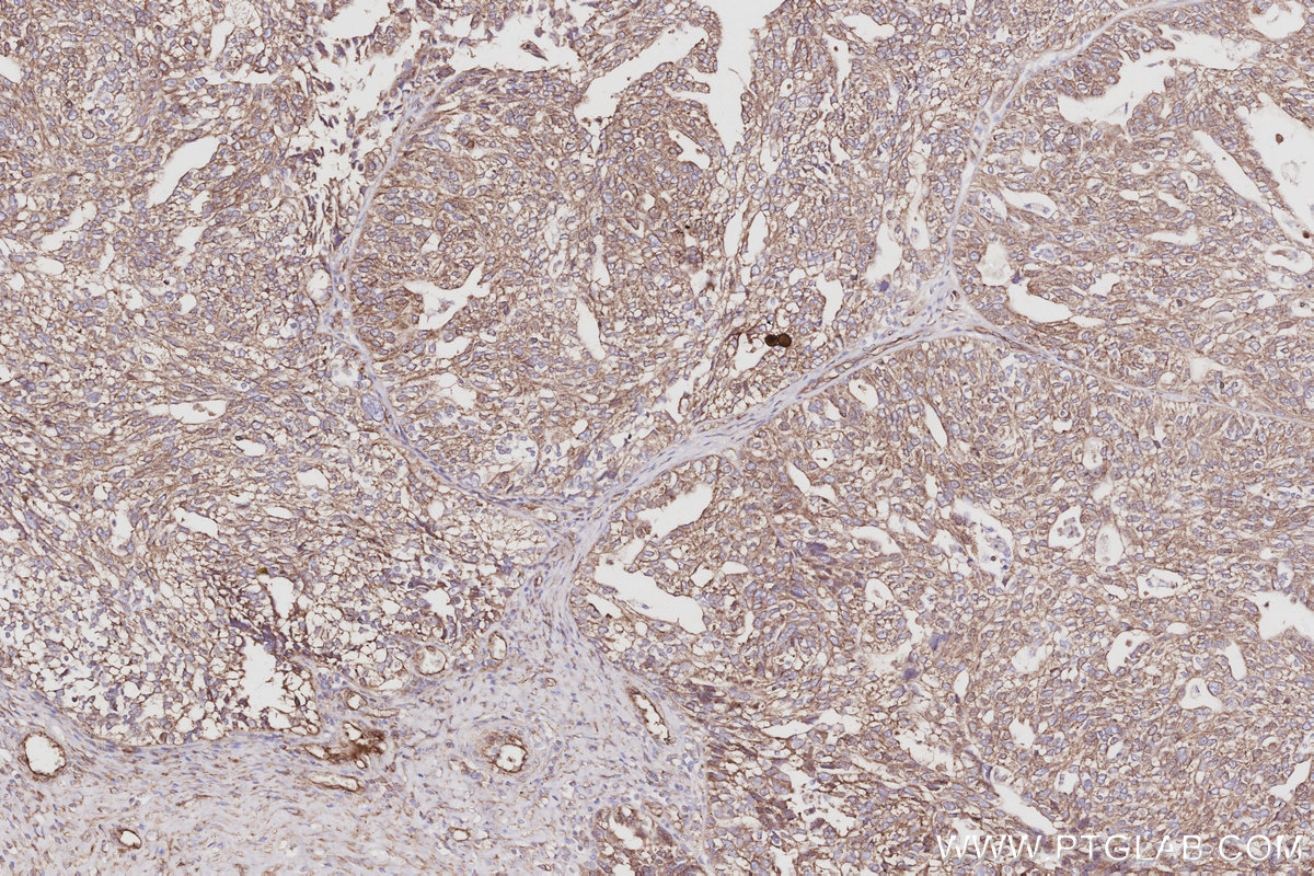 IHC staining of human ovary cancer using 85142-2-RR