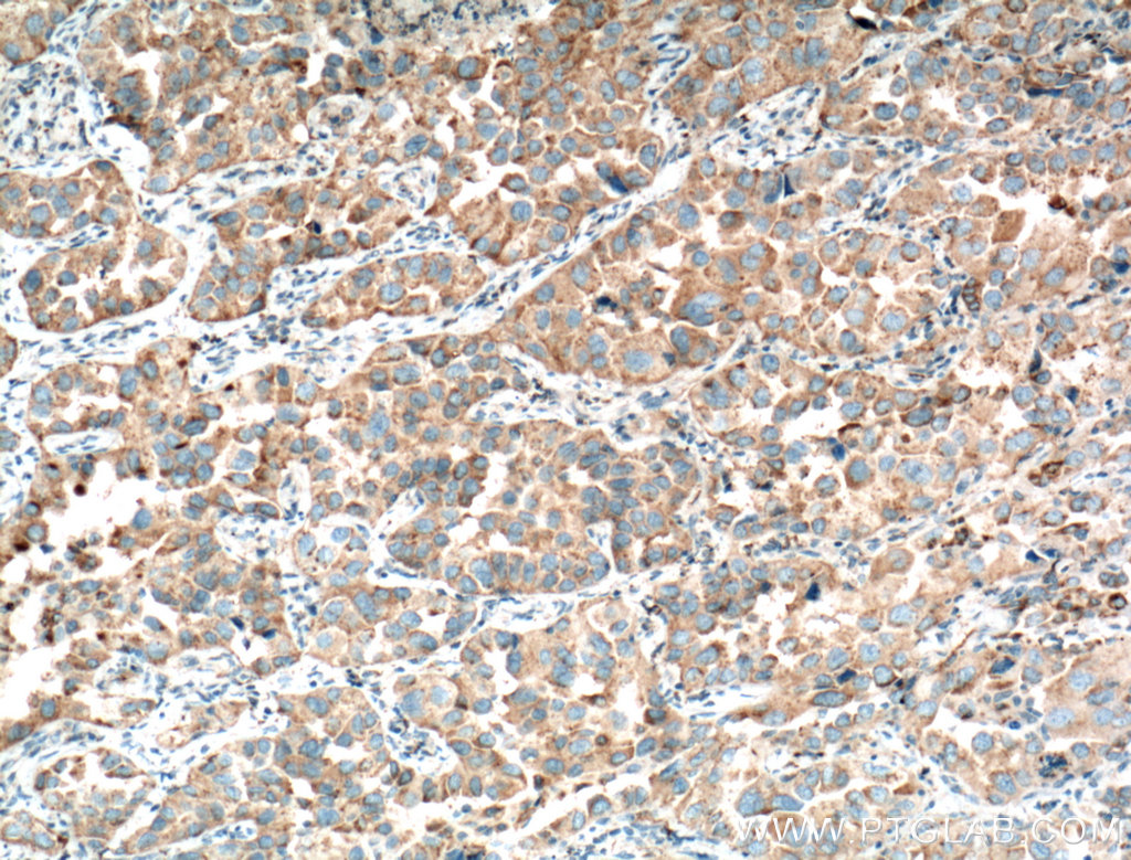 IHC staining of human lung cancer using 16558-1-AP