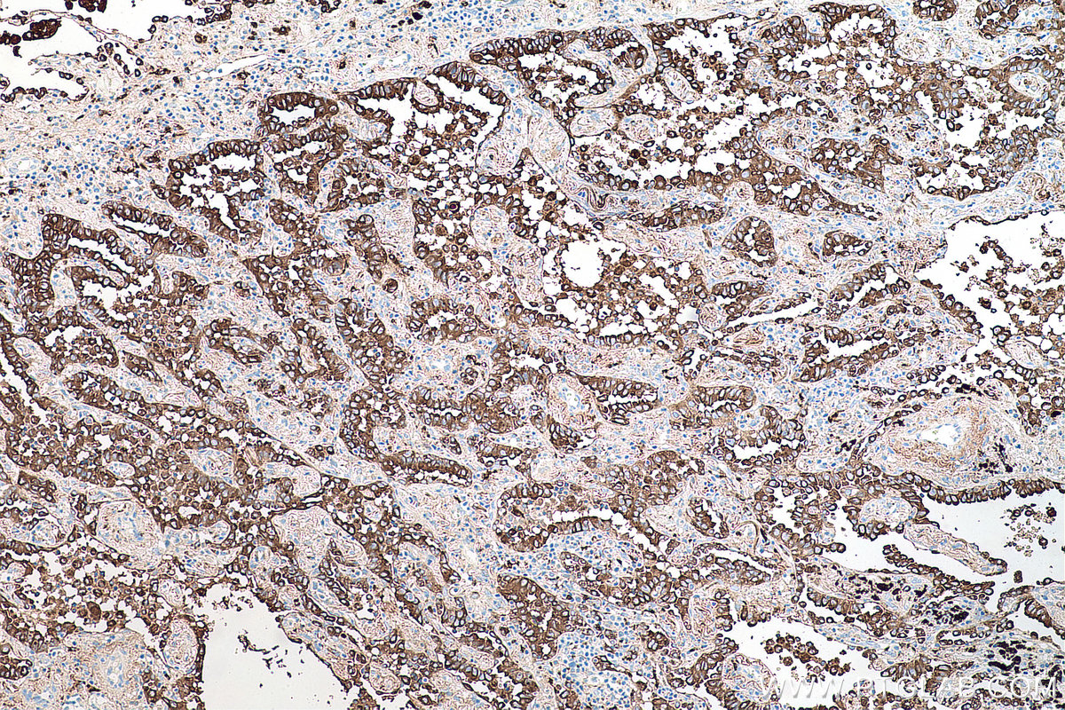 IHC staining of human lung cancer using 60259-2-Ig IHC staining of human lung cancer using 60259-2-Ig