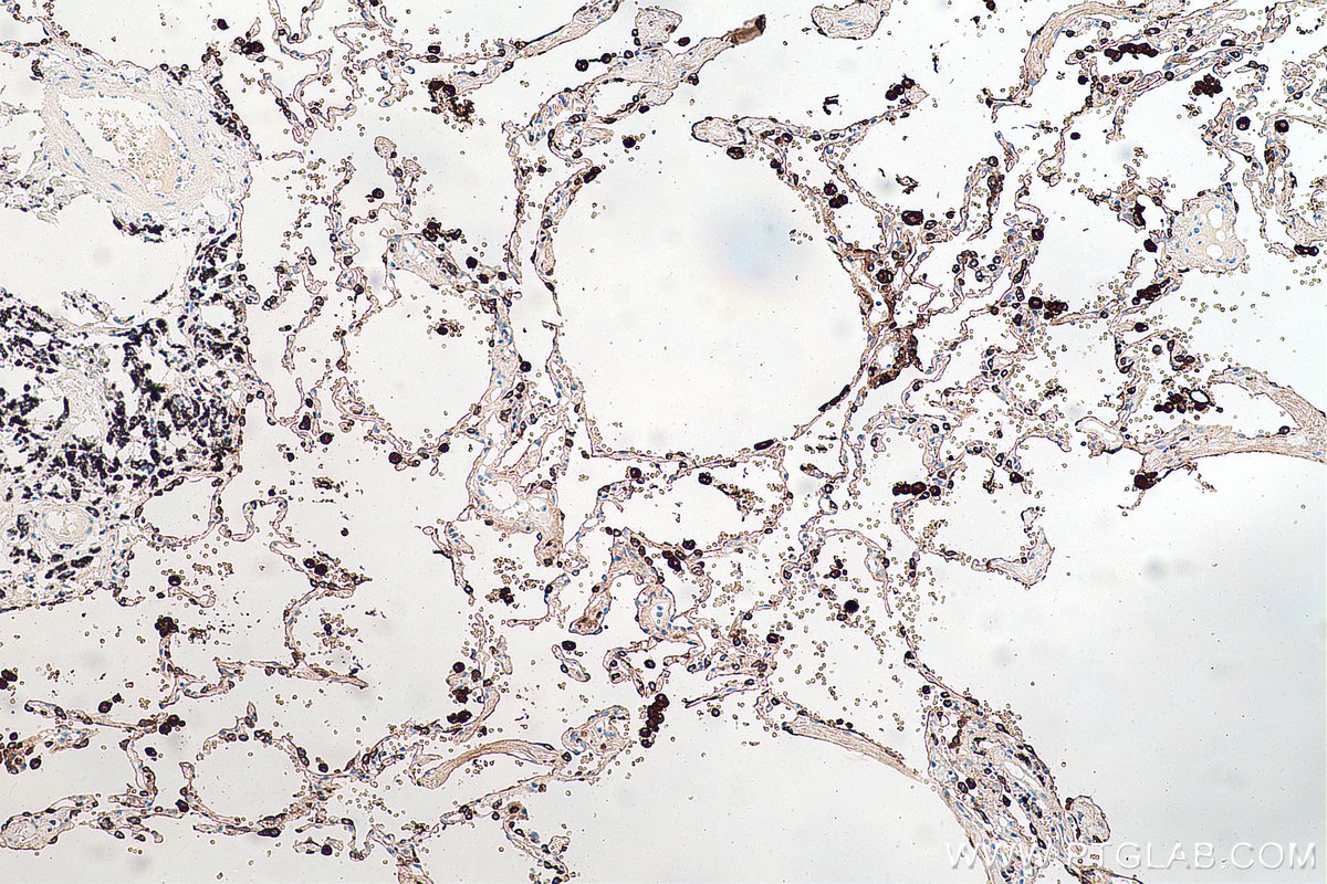 IHC staining of human lung cancer using 60259-2-Ig IHC staining of human lung cancer using 60259-2-Ig