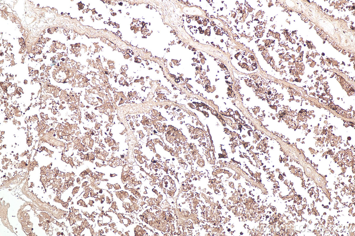 IHC staining of human ovary tumor using 60259-2-Ig IHC staining of human ovary tumor using 60259-2-Ig