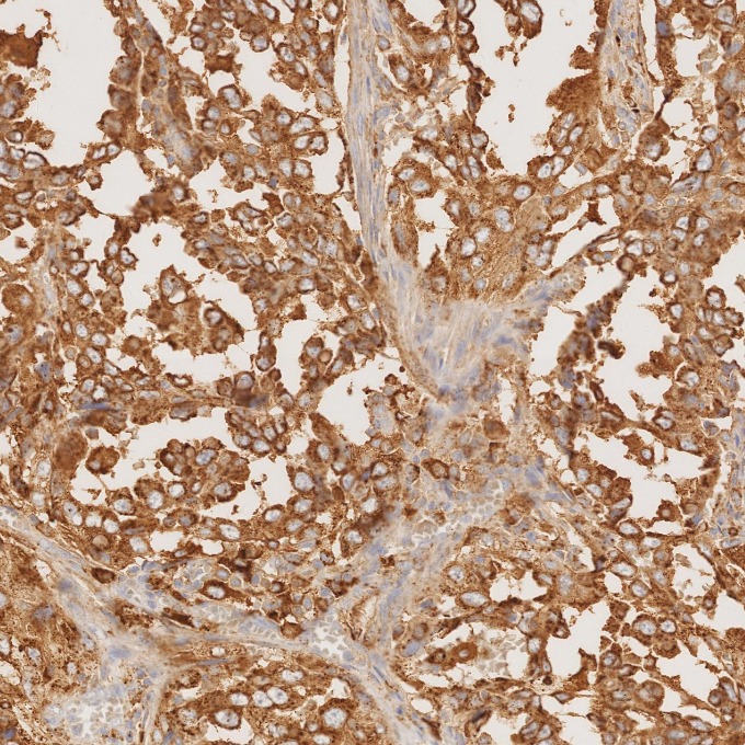 IHC staining of human lung cancer using 60259-2-Ig IHC staining of human lung cancer using 60259-2-Ig