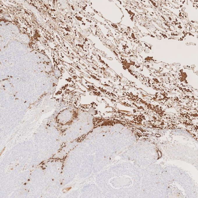 IHC staining of human lung cancer using 60259-2-Ig IHC staining of human lung cancer using 60259-2-Ig