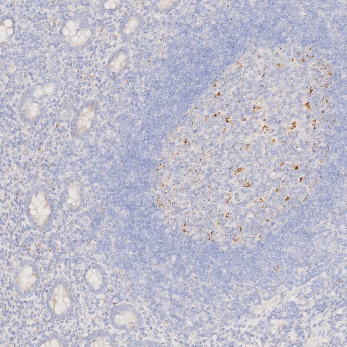 IHC staining of human appendicitis using 60259-2-Ig IHC staining of human appendicitis using 60259-2-Ig