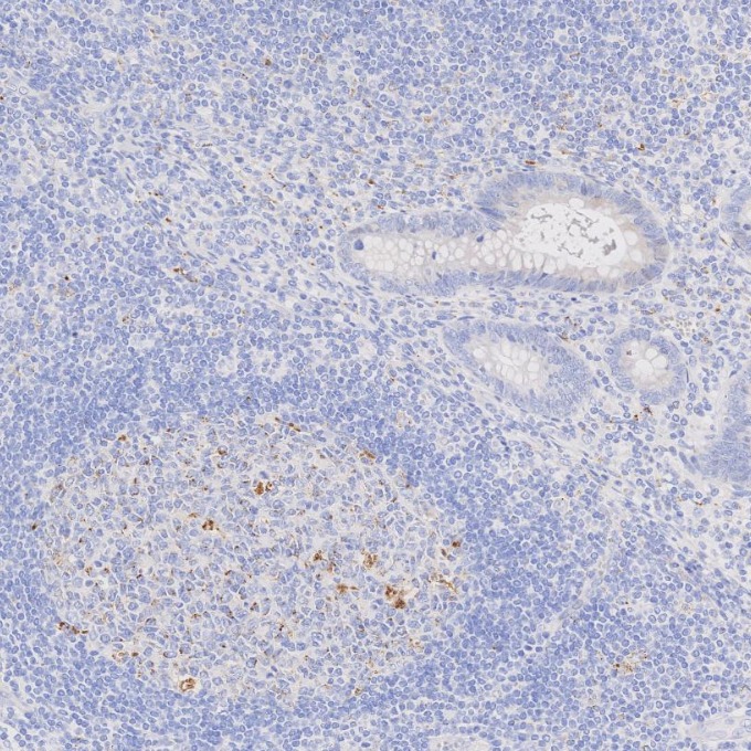 IHC staining of human appendicitis using 60259-2-Ig IHC staining of human appendicitis using 60259-2-Ig