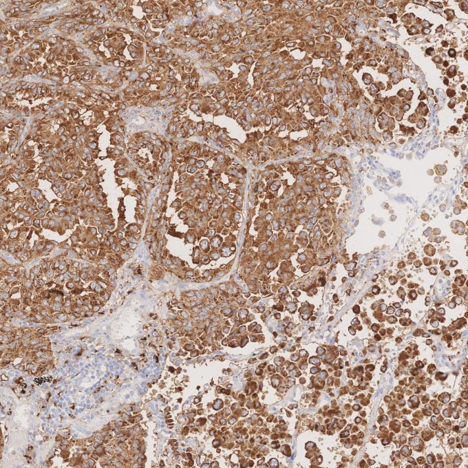 IHC staining of human lung cancer using 60259-2-Ig IHC staining of human lung cancer using 60259-2-Ig