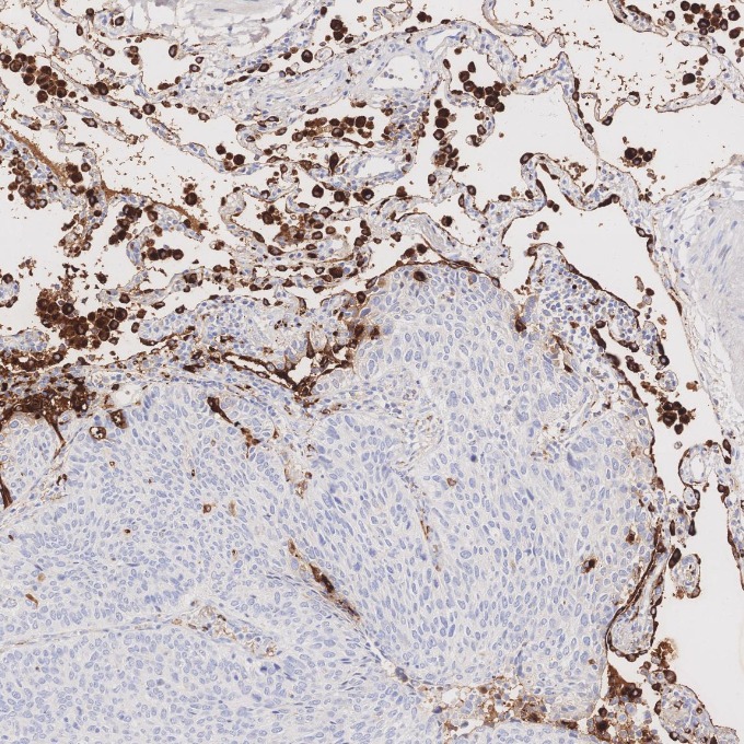 IHC staining of human lung cancer using 60259-2-Ig IHC staining of human lung cancer using 60259-2-Ig