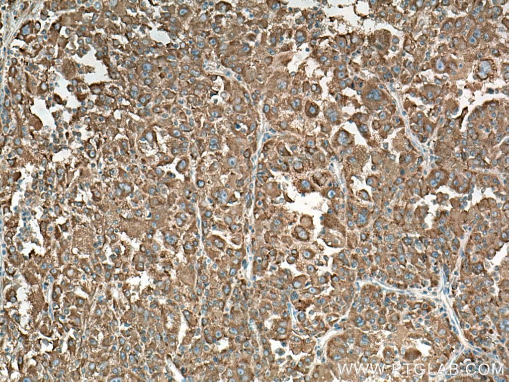 IHC staining of human liver cancer using 14882-1-AP