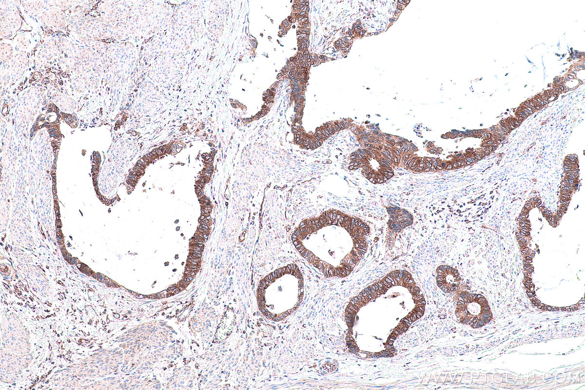 IHC staining of human urothelial carcinoma using 67711-1-Ig