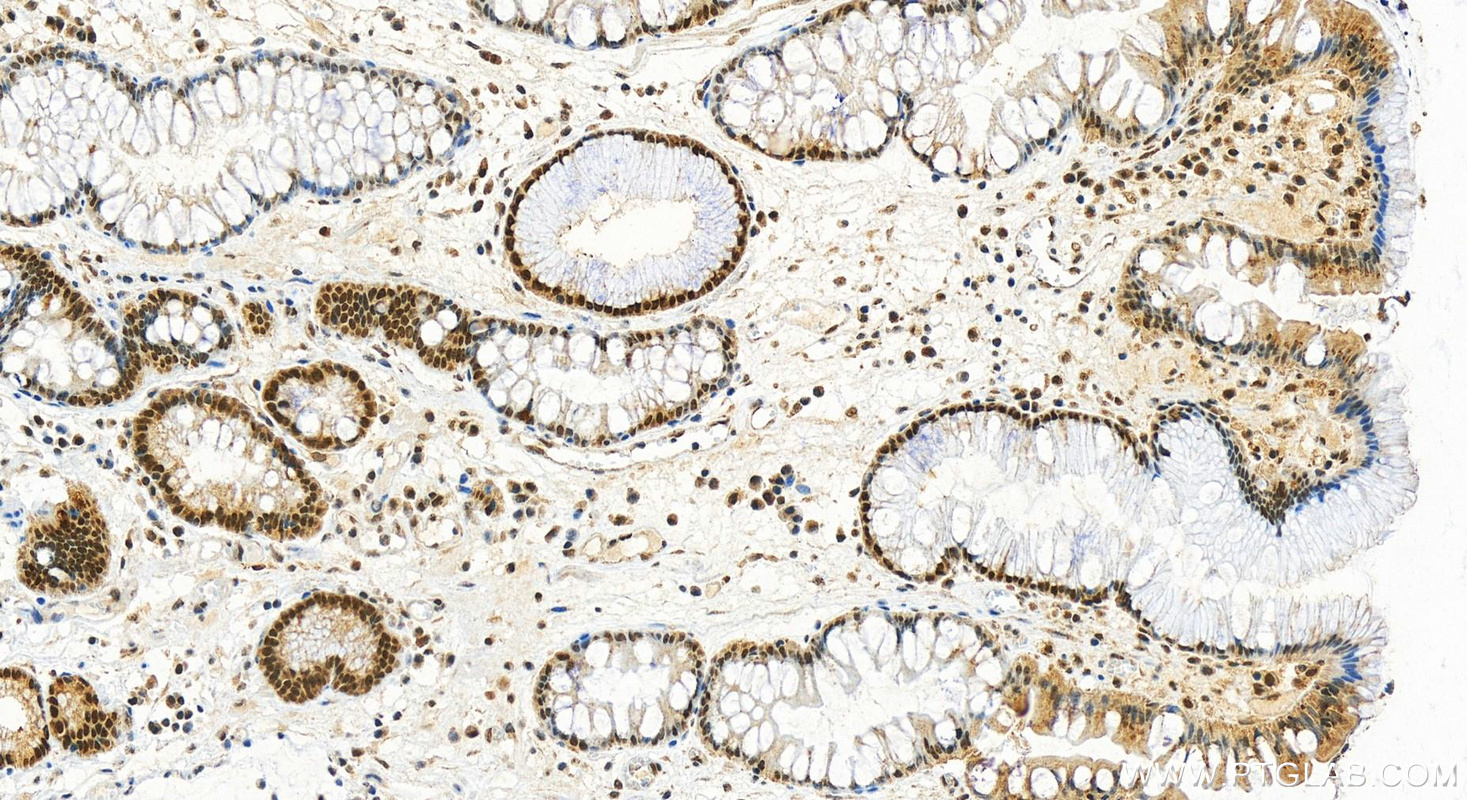 IHC staining of human stomach cancer using 13365-1-AP
