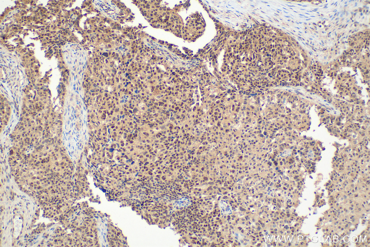 Immunohistochemical analysis of paraffin-embedded human ovary cancer tissue slide using 13365-1-AP (NAT10 antibody) at dilution of 1:2000 (under 20x lens). Heat mediated antigen retrieval with Tris-EDTA buffer (pH 9.0). IHC staining of human ovary cancer using 13365-1-AP