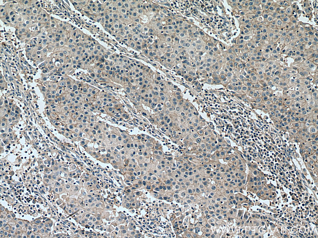 IHC staining of human breast cancer using 11410-1-AP