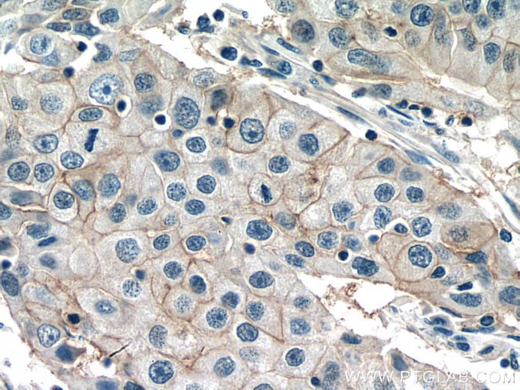 IHC staining of human breast cancer using 11410-1-AP