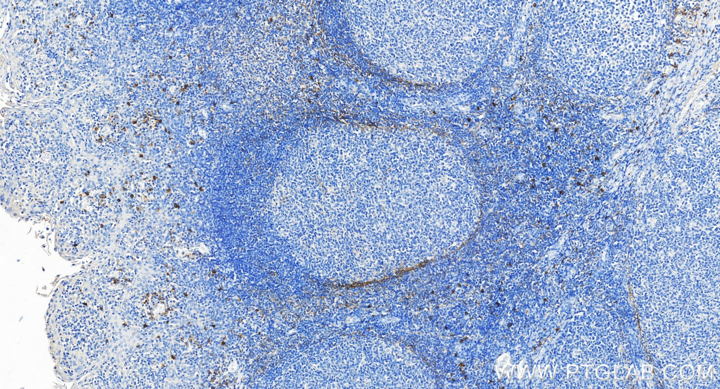 IHC staining of human tonsillitis using 14255-1-AP