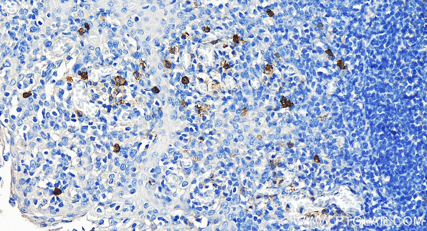 IHC staining of human tonsillitis using 14255-1-AP