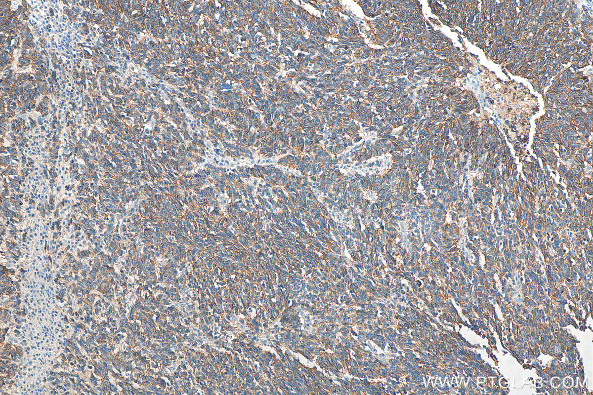 IHC staining of human lung cancer using 60238-1-Ig (same clone as 60238-1-PBS)