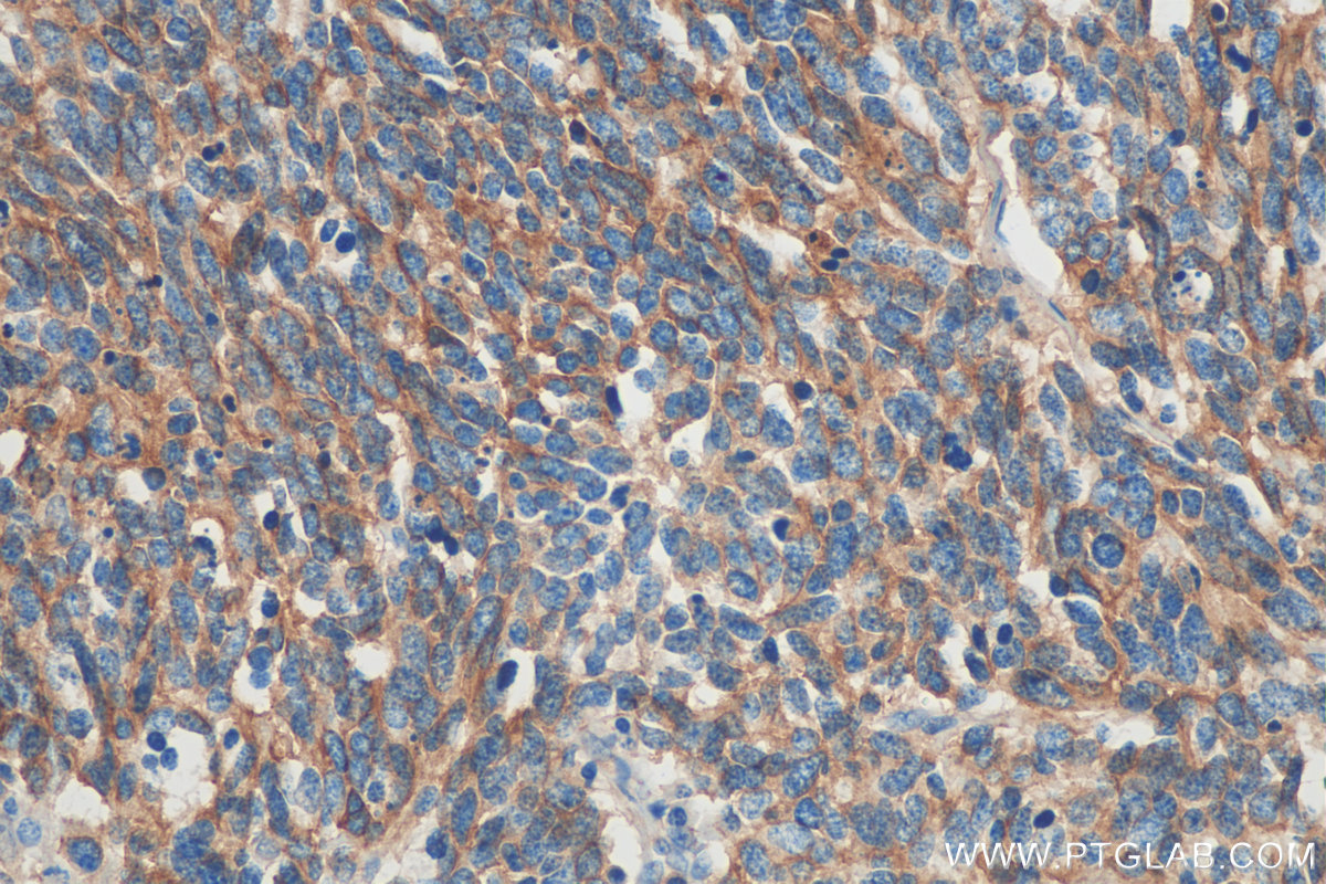 IHC staining of human lung cancer using 60238-1-Ig (same clone as 60238-1-PBS)