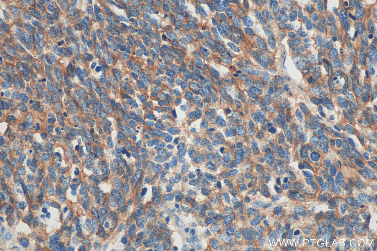 IHC staining of human lung cancer using 60238-1-Ig