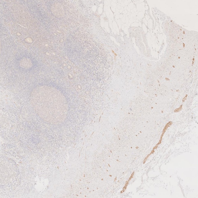 IHC staining of human appendicitis using 60238-1-Ig