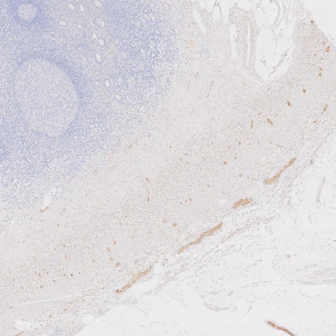 IHC staining of human appendicitis using 60238-1-Ig