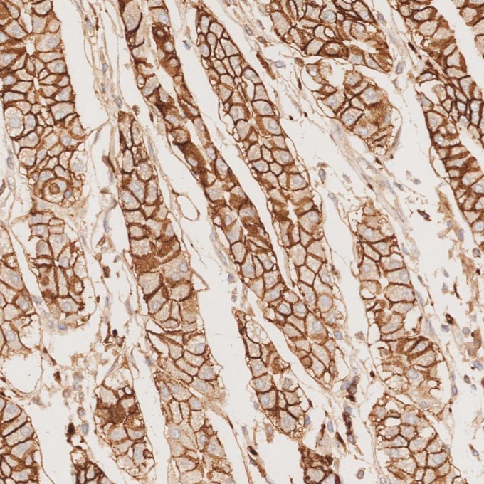 IHC staining of human stomach cancer using 82715-1-RR IHC staining of human stomach cancer using 82715-1-RR