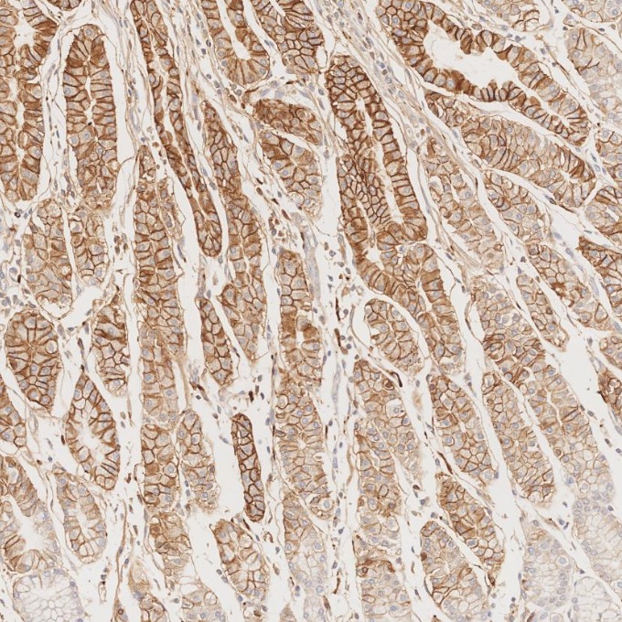 IHC staining of human stomach cancer using 82715-1-RR IHC staining of human stomach cancer using 82715-1-RR