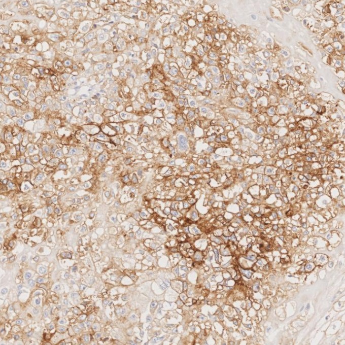 IHC staining of human stomach cancer using 82715-1-RR IHC staining of human stomach cancer using 82715-1-RR