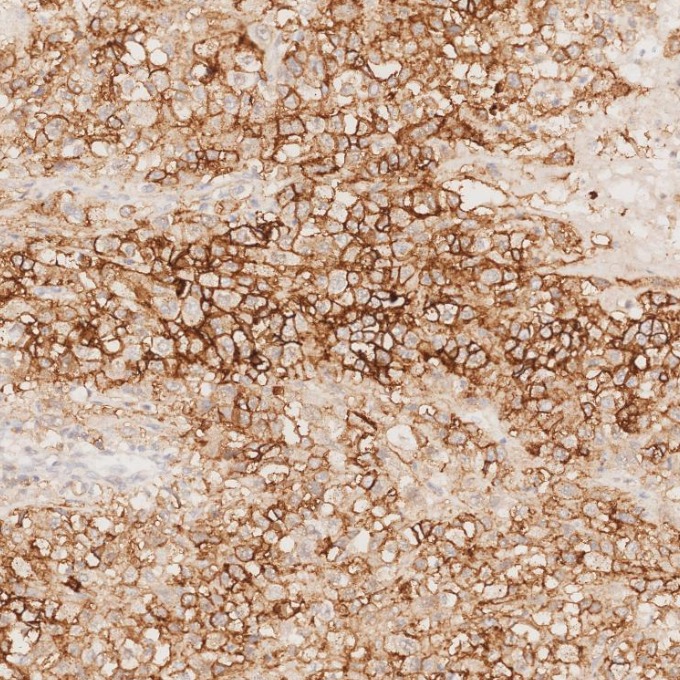 IHC staining of human stomach cancer using 82715-1-RR IHC staining of human stomach cancer using 82715-1-RR