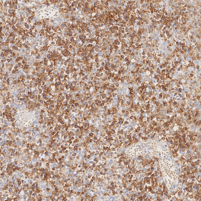 IHC staining of human lymphoma using 82715-1-RR IHC staining of human lymphoma using 82715-1-RR