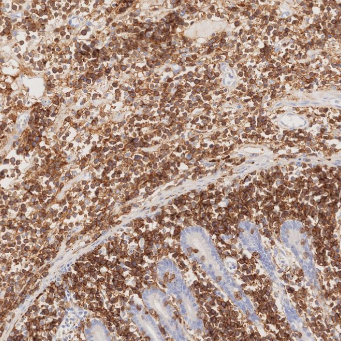 IHC staining of human lymphoma using 82715-1-RR IHC staining of human lymphoma using 82715-1-RR