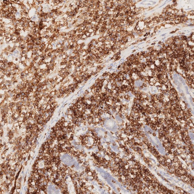 IHC staining of human lymphoma using 82715-1-RR IHC staining of human lymphoma using 82715-1-RR