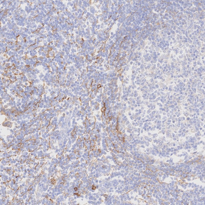 IHC staining of human tonsillitis using 82715-1-RR IHC staining of human tonsillitis using 82715-1-RR