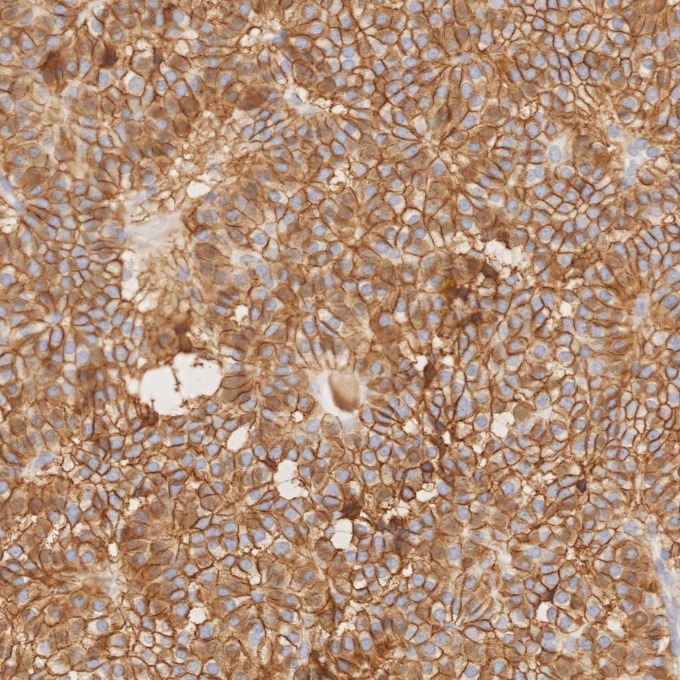 IHC staining of human pituitary adenoma using 82715-1-RR IHC staining of human pituitary adenoma using 82715-1-RR