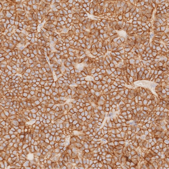 IHC staining of human pituitary adenoma using 82715-1-RR IHC staining of human pituitary adenoma using 82715-1-RR