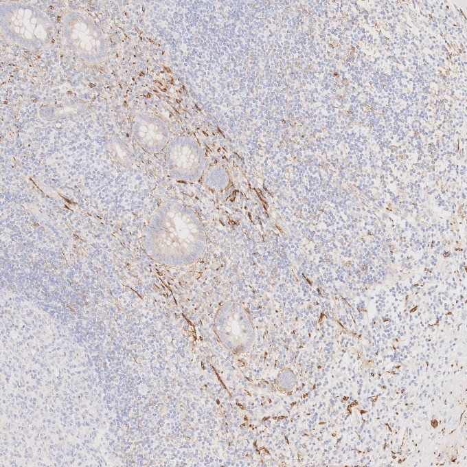 IHC staining of human appendicitis using 82715-1-RR IHC staining of human appendicitis using 82715-1-RR
