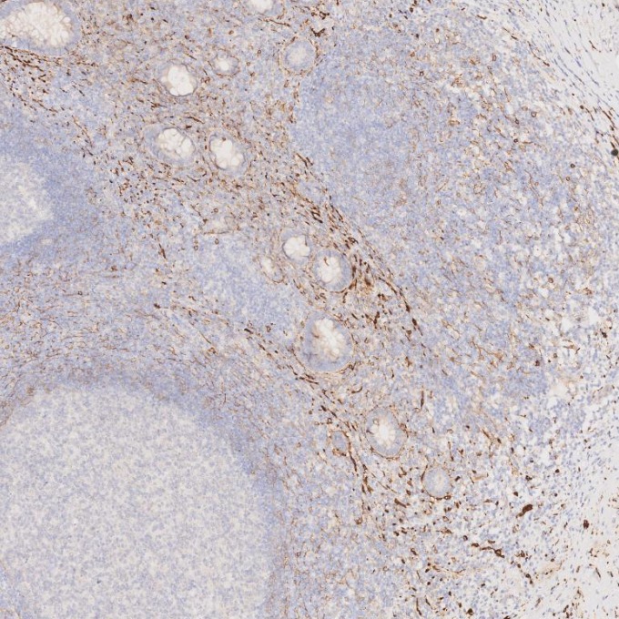 IHC staining of human appendicitis using 82715-1-RR IHC staining of human appendicitis using 82715-1-RR