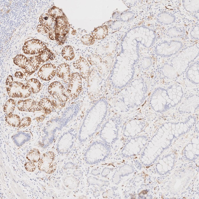 IHC staining of human stomach cancer using 82715-3-RR IHC staining of human stomach cancer using 82715-3-RR