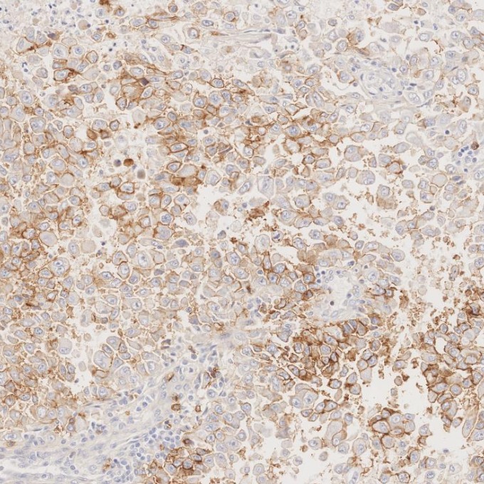 IHC staining of human stomach cancer using 82715-3-RR IHC staining of human stomach cancer using 82715-3-RR