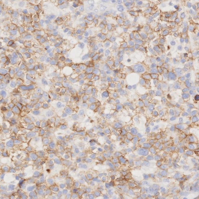 IHC staining of human lymphoma using 82715-3-RR IHC staining of human lymphoma using 82715-3-RR