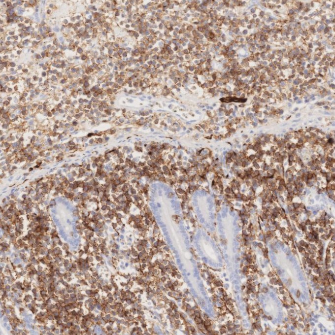 IHC staining of human lymphoma using 82715-3-RR IHC staining of human lymphoma using 82715-3-RR