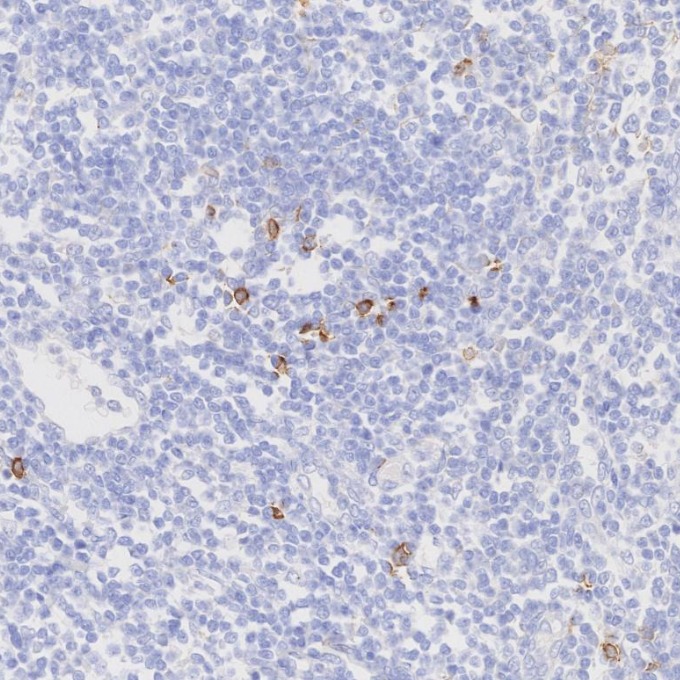 IHC staining of human tonsillitis using 82715-3-RR IHC staining of human tonsillitis using 82715-3-RR