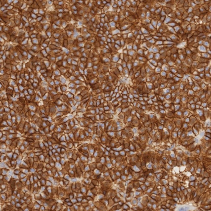 IHC staining of human pituitary adenoma using 82715-3-RR IHC staining of human pituitary adenoma using 82715-3-RR