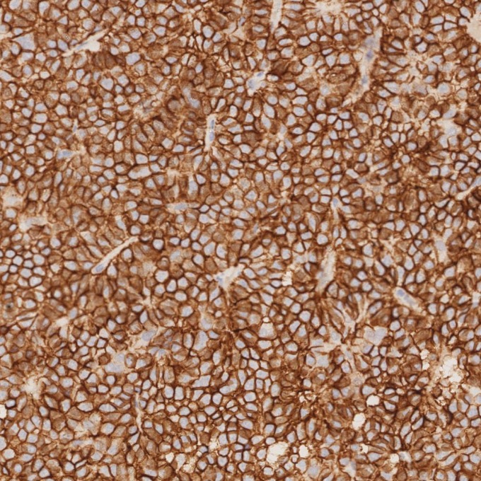 IHC staining of human pituitary adenoma using 82715-3-RR IHC staining of human pituitary adenoma using 82715-3-RR