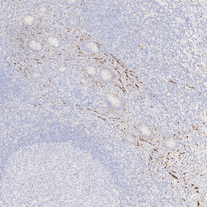 IHC staining of human appendicitis using 82715-3-RR IHC staining of human appendicitis using 82715-3-RR