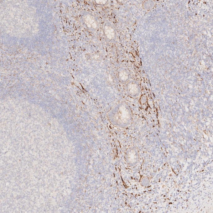 IHC staining of human appendicitis using 82715-3-RR IHC staining of human appendicitis using 82715-3-RR